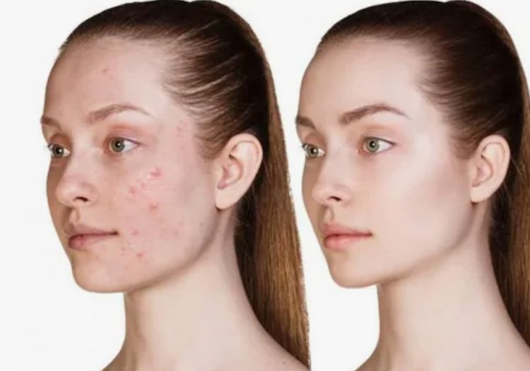 Before &After